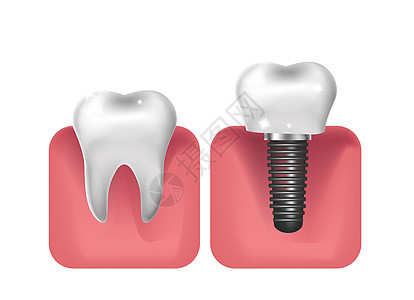 牙种植体假体 3D 逼真风格 牙科健康牙齿的概念 它制作图案矢量牙科搪瓷技术假体药品手术插图磨牙原理图口腔科图片