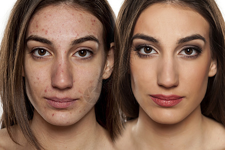 一个皮肤有问题的女人的肖像 不带和配着豆子睫毛治疗粉刺皮肤科毛孔美容阴影感染化妆品护理图片