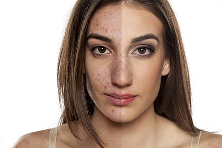 一个皮肤有问题的女人的肖像 不带和配着豆子女士阴影化妆品女孩感染疙瘩睫毛美容皮肤科斑点图片