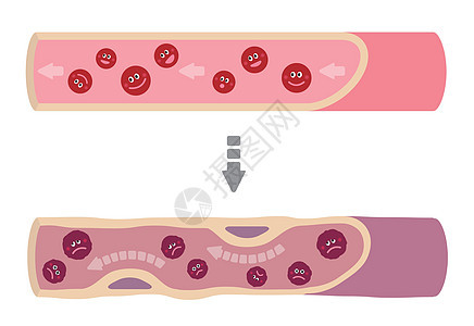 健康血液因各种不健康因素导致动脉硬化而变得浑浊的例证科学疾病载体静脉中风梗死动脉解剖学攻击插图图片