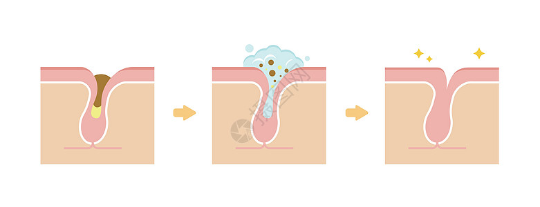 毛孔结构示意图 清除角质栓塞白头 清洁后的黑头皮肤打扫表皮皮肤科治疗真皮细胞气泡载体组织背景图片