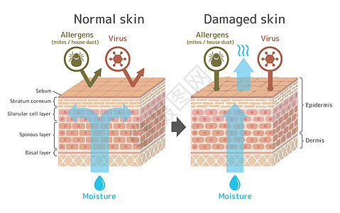 皮肤剖面图 健康皮肤与受伤滑雪者保护效果对比图损害细胞细菌学校药品绘画皮脂卫生真皮水分图片