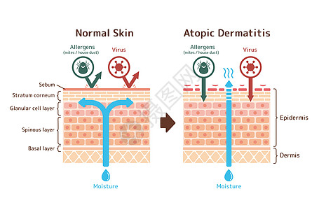特应性皮炎和正常皮肤比较的截面图卫生疼痛病人湿疹过敏皮肤科解剖学表皮治疗保健图片