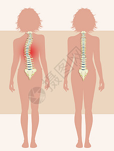 患有骨质疏松症的女童药品脊椎疼痛骨头解剖学脊柱插图神经关节女士图片