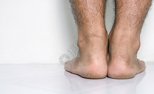 男人脚皮的鞋跟破碎皮革疼痛男性疾病皮肤科裂缝脚跟皮肤女性赤脚图片