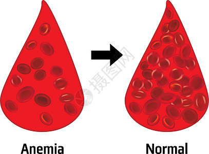 贫血和正常红血细胞沉积血细胞药品科学插图血液学生物愈合化学治愈生物学图片