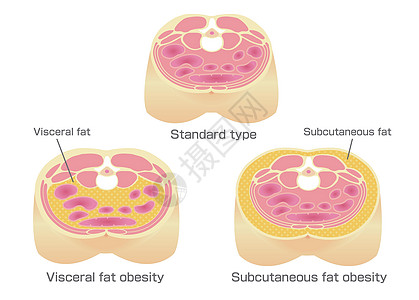日本的肥胖插图类型 腹部剖视图 内脏脂肪 皮下脂肪损失男性器官疾病医疗数字代谢保健卫生身体图片
