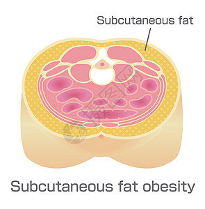 日本的肥胖插图类型 腹部剖视图皮下脂肪损失身体重量糖尿病饮食科学医疗器官卫生生物学图片