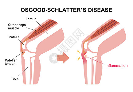 病膝关节病它制作图案插图伤害疾病骨骼肌腱髌腱髌骨生物学解剖学软骨图片