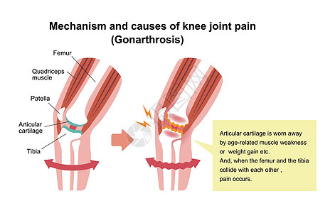 膝关节疼痛的机制和原因 膝关节炎 骨关节炎 膝关节 平面插图骨科器官关节药品节炎治疗保健卫生骨骼膝关节病图片