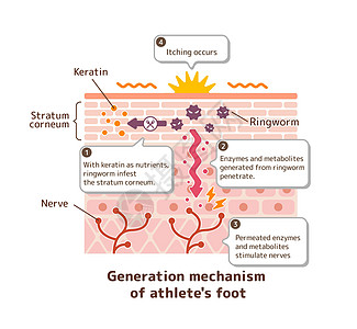脚癣病媒制作图案的产生机制感染肿胀手指疾病皮肤痛苦治疗皮炎保健角质层图片