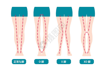 角度不同不同类型的腿部角度和膝盖矢量图解 正常保龄球腿外翻手术膝关节炎保健股骨骨科治疗外科疾病女士女性插画