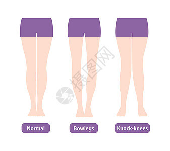 不同类型的腿部角度和膝盖矢量图解 正常保龄球腿外翻保健身体疼痛膝关节炎脚骨平衡治疗骨科外科股骨图片