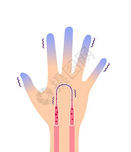 冷手血液循环图示对冷指尖的敏感性蓝色器官流感卡通片寒冷疼痛女士手指疾病状况图片