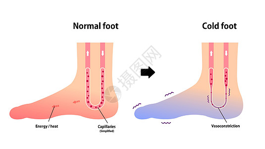 正常足和冷足对冷脚趾敏感度的比较图症状插图卡通片女士身体疼痛寒潮流感女性器官图片