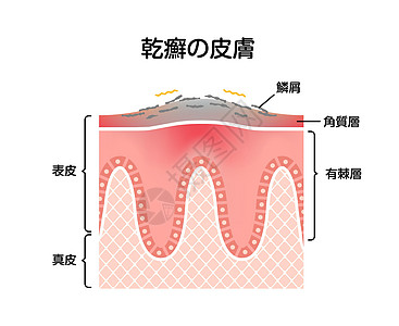 牛皮癣皮肤扁平载体它制作图案的横截面药品疼痛皮肤科症状感染科学牌匾细胞疾病身体图片