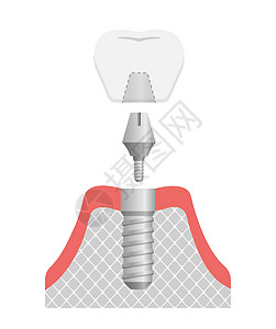 牙科植入物平面矢量图 No tex手术外科陶瓷诊所牙医解剖学磨牙假牙横截面插图图片