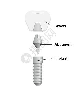 它制作图案的牙科植入物平面矢量渲染诊所卡通片解剖学磨牙横截面医院牙龈假肢牙齿图片
