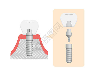 牙科植入物平面矢量图 No tex假肢牙齿渲染陶瓷卡通片诊所牙龈磨牙凹痕搪瓷图片
