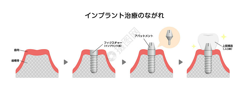 牙科植入过程平面矢量图日本药品医院假肢插图陶瓷凹痕渲染牙龈手术假牙图片