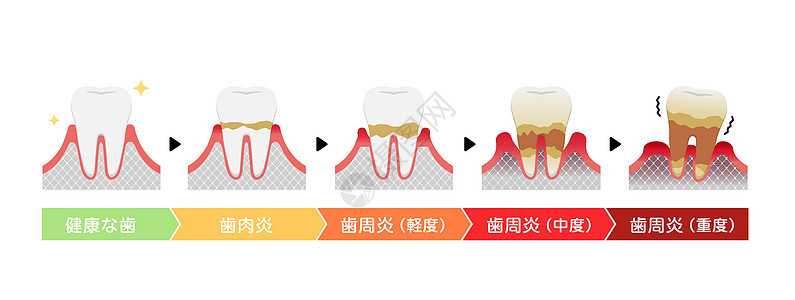 牙周炎病媒它制作图案的阶段保健口臭治疗牙疼本质口腔插图横截面细菌疼痛图片