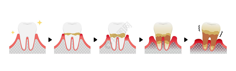 卫生保健牙周炎病媒它制作图案的阶段插图疾病护理清洁度医疗口臭细菌牙齿横截面口服插画