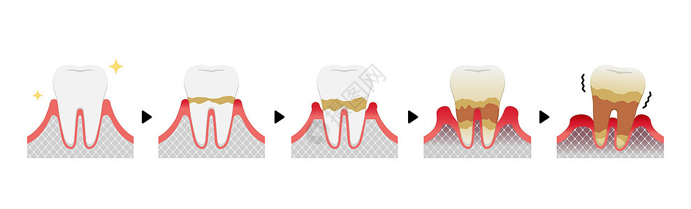 牙周炎病媒它制作图案的阶段插图疾病护理清洁度医疗口臭细菌牙齿横截面口服图片