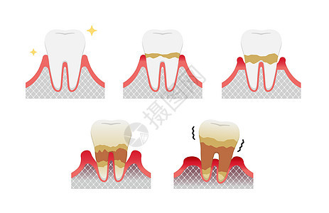 牙周炎病媒它制作图案的阶段牙齿治疗搪瓷插图牙周口臭口服牙医感染保健图片