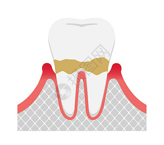 牙周炎疾病的阶段 轻度牙周炎图片