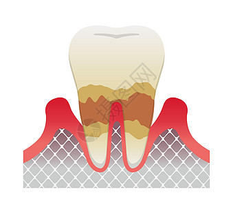 牙周炎疾病的阶段 中度牙周炎图片