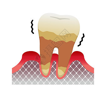 牙周炎疾病的阶段严重牙周炎图片