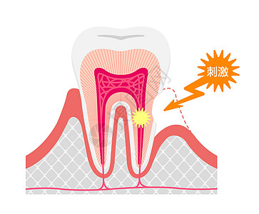 日本牙齿敏感病媒图解的成因与机制搪瓷卫生刺激牙科疼痛口服治疗插图诊所空腔图片