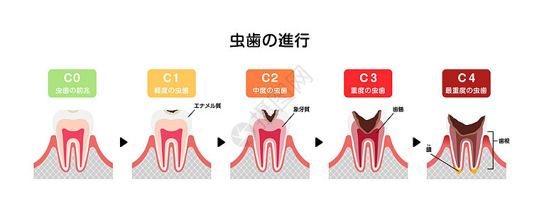 日本蛀牙平面矢量图解的各个阶段诊所本质搪瓷插图牙齿疾病脓肿保健疼痛牙疼图片