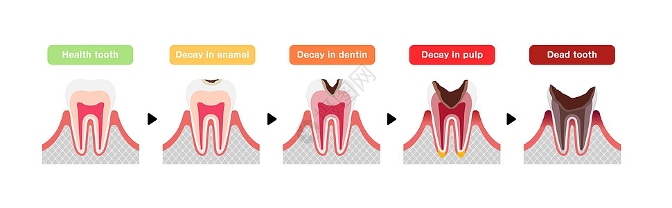 蛀牙平面向量它制作图案的阶段磨牙疾病解剖学图表脓肿搪瓷衰变空腔卡通片卫生图片