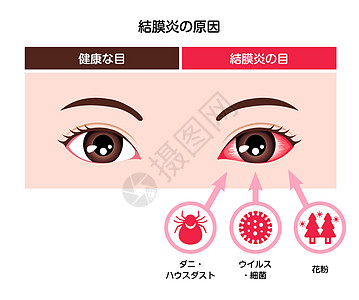 它制作图案的结膜炎粉红色眼病媒的成因插图结膜医生细菌感染疼痛发烧症状过敏眼球图片