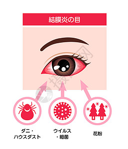 它制作图案的结膜炎粉红色眼病媒的成因发烧眼科插图医生感染血丝诊所细菌验光流感图片