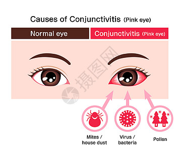 它制作图案的结膜炎粉红色眼病媒的成因眼球流感血丝医生症状细菌结膜疾病感染过敏图片