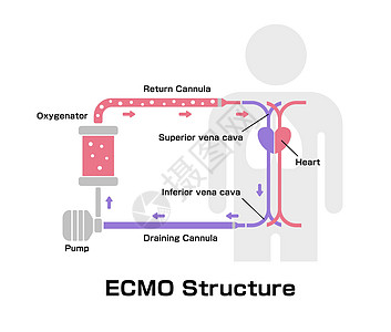 ECMO体外膜氧合结构载体制作图案图片