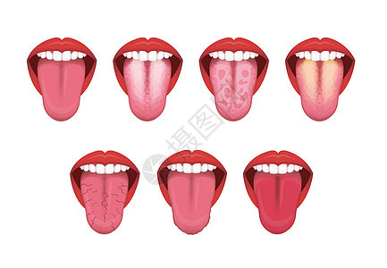 舌头健康标志矢量图 se呼吸真菌解剖学症状疾病治疗牙齿细菌药品念珠菌图片