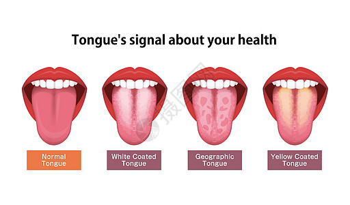 舌头健康标志矢量图白色涂层舌头口臭卫生画眉感染病人药品女士细菌治疗念珠菌图片