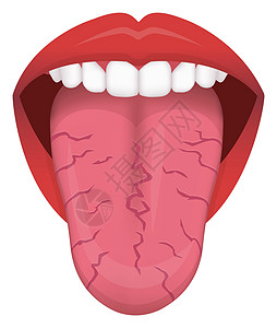 舌头健康标志矢量图裂纹舌图片