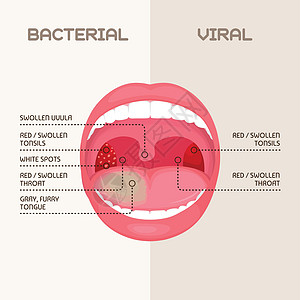 喉咙细菌和病毒感染扁桃体发炎组织链球菌心绞痛咽炎腺体症状插图药品疾病感染图片