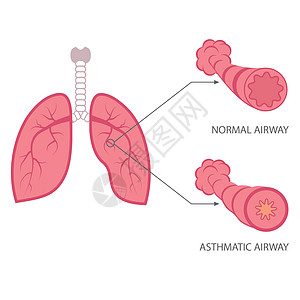 哮喘肺部呼吸系统疾病图片