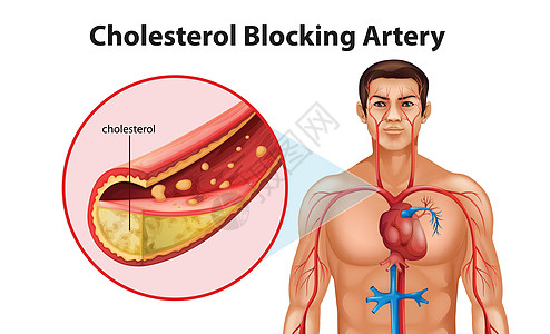 动脉硬化疾病致命艺术插图牌匾导管支架动脉粥样硬化攻击心脏病图片