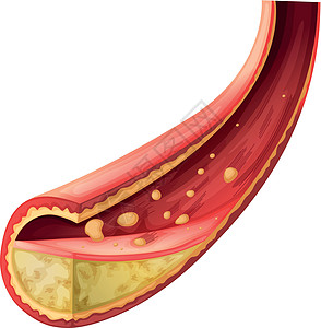 动脉被胆固醇阻塞图片