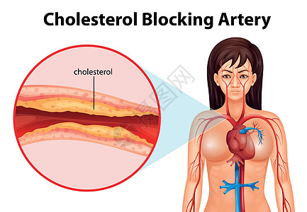 动脉硬化疾病插图细胞致命组织导管牌匾硬化血管死亡图片