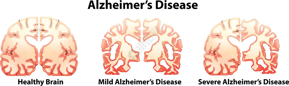 阿尔茨海默氏病困惑科学思维记忆侵略能力大脑情绪绘画压力图片
