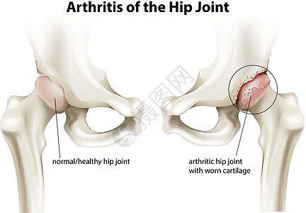髋关节关节炎白色习惯性接头绘画外观关节意义滑膜运动髋关节炎图片
