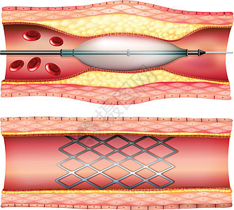 支架血管成形术科学麻醉专家治疗教育心脏病阀门药物局部管子背景图片