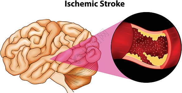 脑白色学习图表神经墙纸器官卡通片中风图片